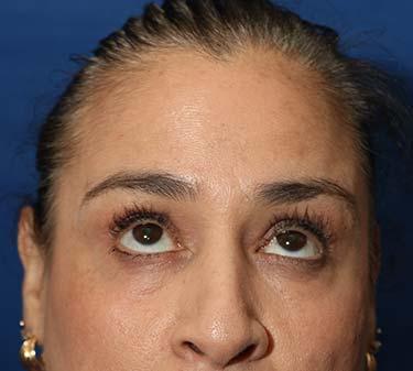 After Results for Neuromodulators (Botox / Dysport)