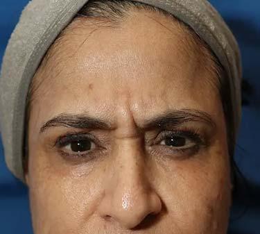 Before Results for Neuromodulators (Botox / Dysport)