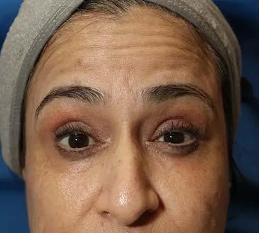 Before Results for Neuromodulators (Botox / Dysport)