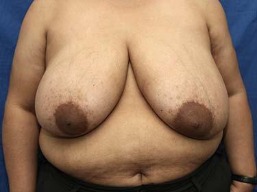 Before Results for Breast Reduction