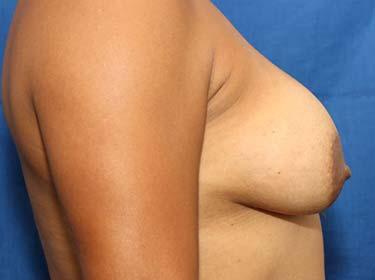 After Results for Breast Augmentation