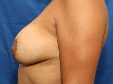 After Results for Breast Augmentation