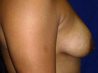 Before Results for Breast Augmentation
