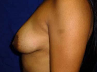 Before Results for Breast Augmentation