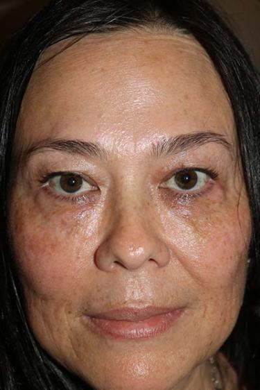 After Results for Neuromodulators (Botox / Dysport), Tissue Fillers