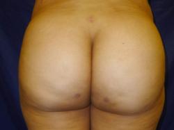 After Results for Gluteal Augmentation