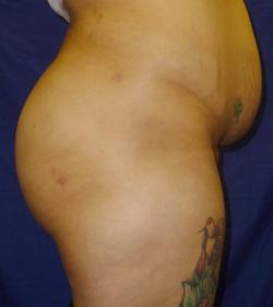 After Results for Gluteal Augmentation