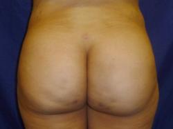 After Results for Gluteal Augmentation