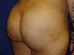 After Results for Gluteal Augmentation