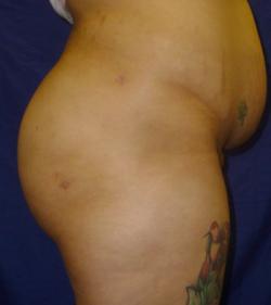 After Results for Gluteal Augmentation