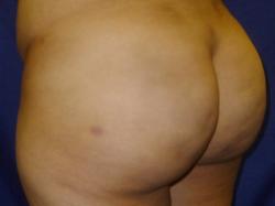 After Results for Gluteal Augmentation