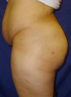 After Results for Gluteal Augmentation