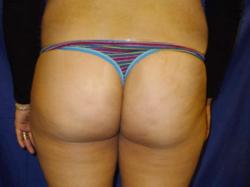 Before Results for Brazilian Butt Lift / Gluteal Augmentation