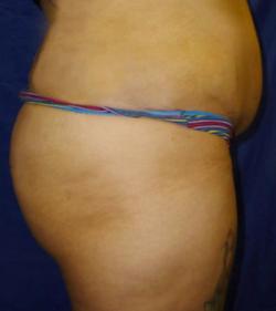 Before Results for Brazilian Butt Lift / Gluteal Augmentation