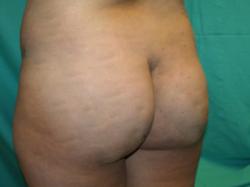 Before Results for Gluteal Augmentation