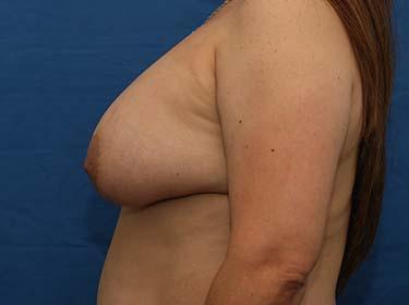 After Results for Breast Augmentation