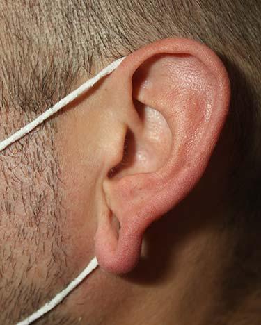 Before Results for Otoplasty