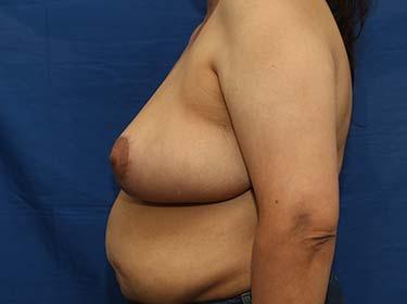 After Results for Breast Reduction