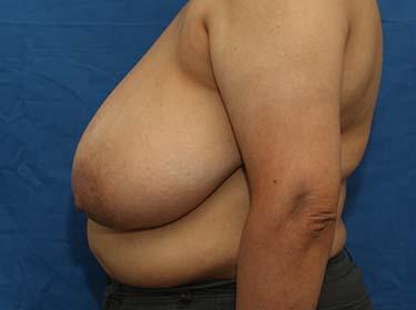 Before Results for Breast Reduction