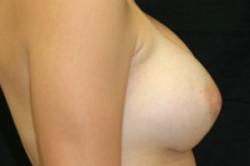 After Results for Breast Augmentation