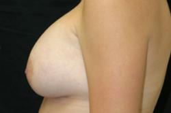 After Results for Breast Augmentation