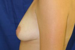 Before Results for Breast Augmentation