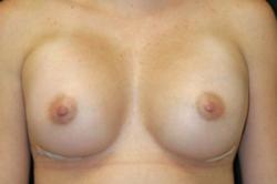 After Results for Breast Augmentation