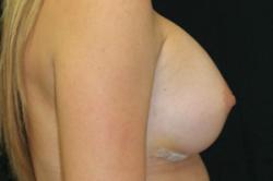 After Results for Breast Augmentation