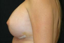 After Results for Breast Augmentation