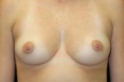 Before Results for Breast Augmentation