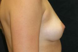 Before Results for Breast Augmentation