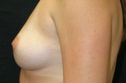 Before Results for Breast Augmentation