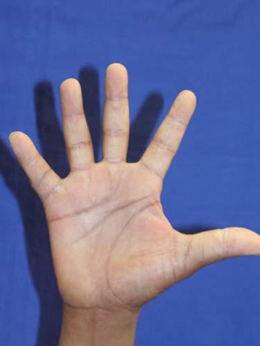 After Results for Hand Surgery