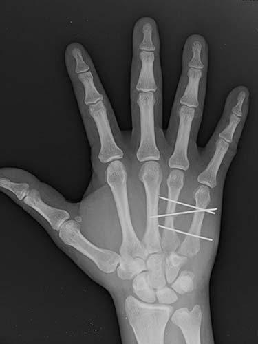 After Results for Hand Surgery
