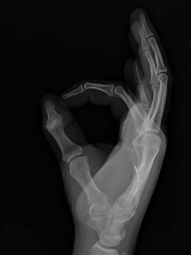 After Results for Hand Surgery