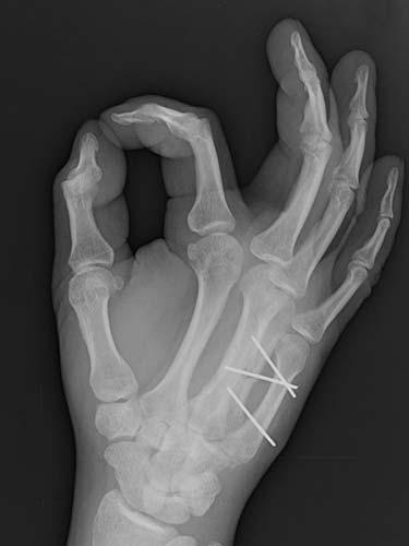 After Results for Hand Surgery