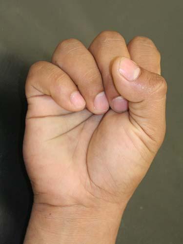 Before Results for Hand Surgery