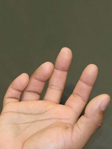 Before Results for Hand Surgery