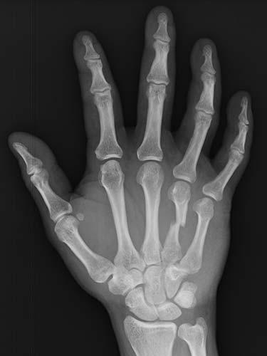 Before Results for Hand Surgery