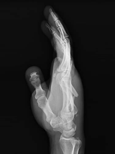 Before Results for Hand Surgery