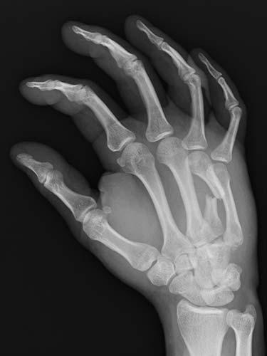 Before Results for Hand Surgery