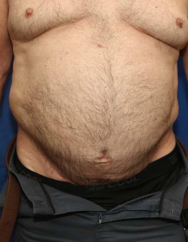 After Results for Liposuction