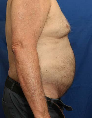 After Results for Liposuction