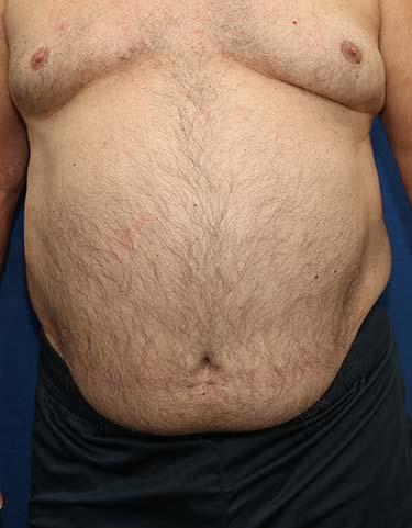 Before Results for Liposuction