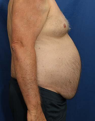 Before Results for Liposuction
