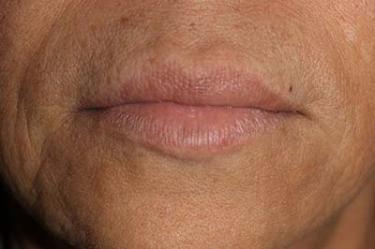 After Results for Tissue Fillers, Lip Augmentation