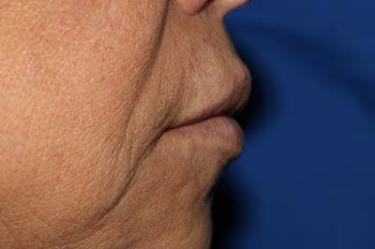 After Results for Tissue Fillers, Lip Augmentation