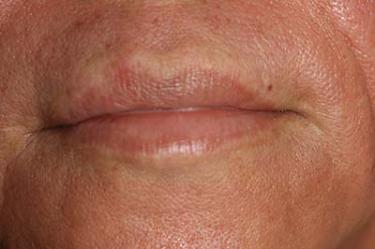 Before Results for Tissue Fillers, Lip Augmentation
