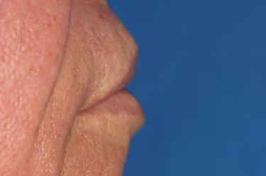 Before Results for Tissue Fillers, Lip Augmentation