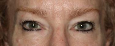 After Results for Blepharoplasty